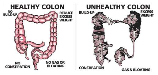 healthy_and_unhealthy_colon1